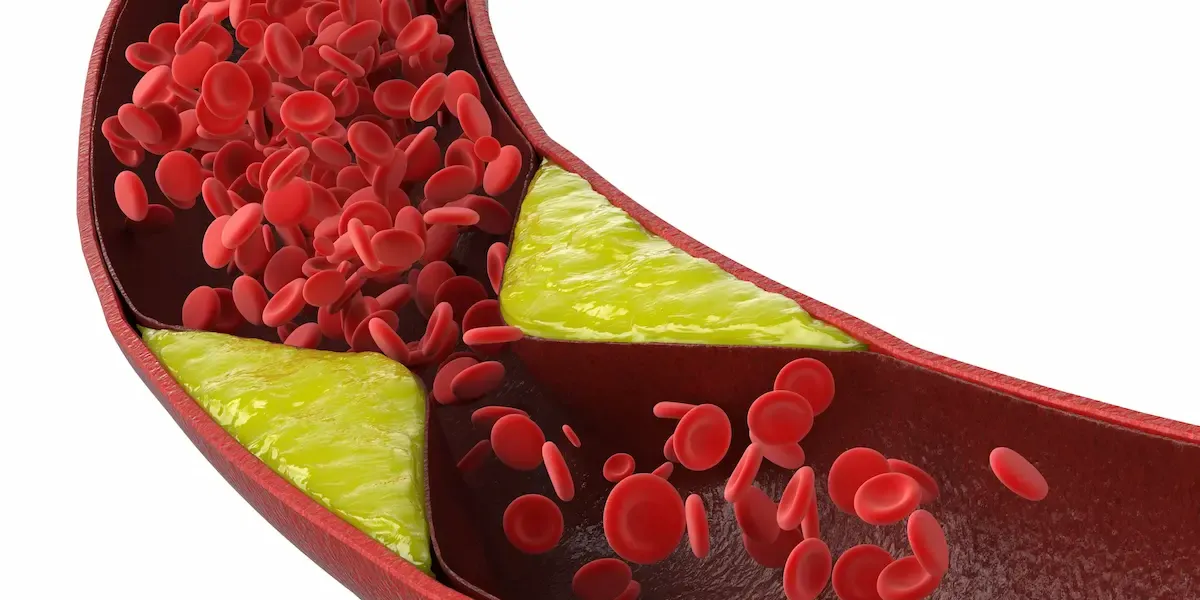 Hipercolesterolemia (Colesterol elevado) :: Recomendaciones dietéticas